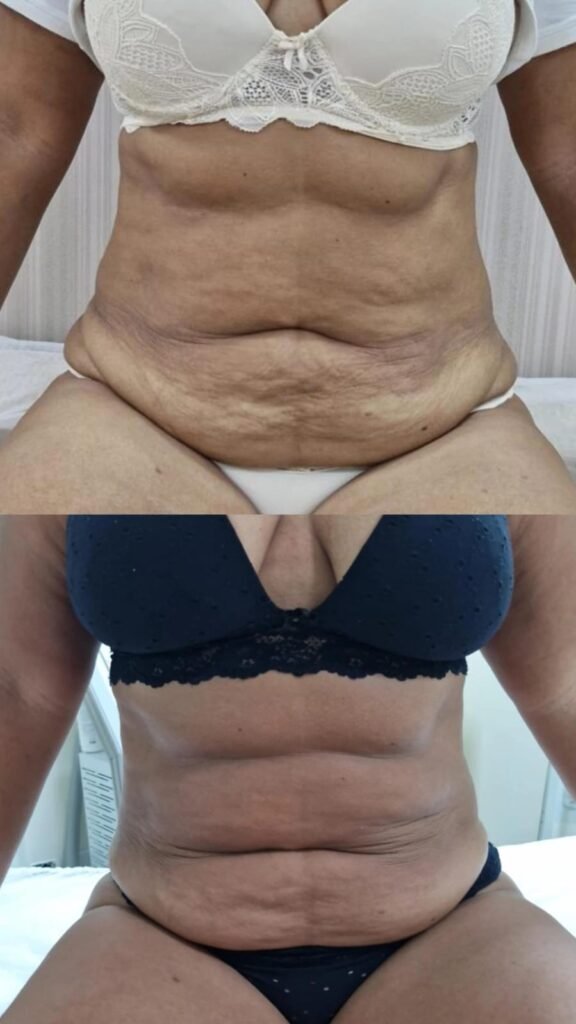 Antes e depois de criolipólise no abdômen - paciente 1 - Clínica Mayara Ribeiro