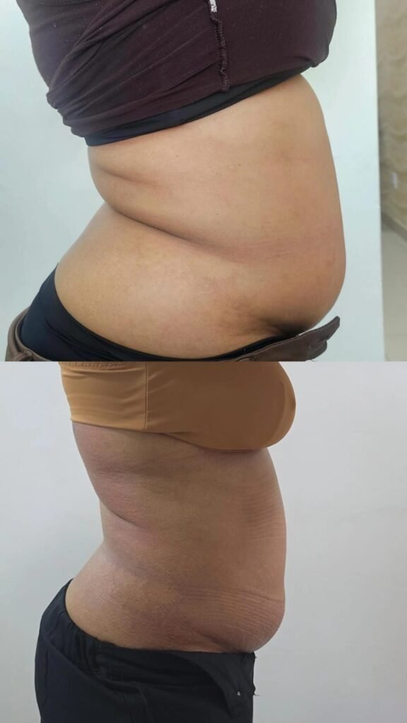 Antes e depois de criolipólise no abdômen - paciente 2 - Clínica Mayara Ribeiro