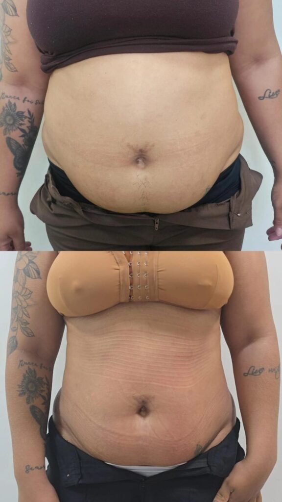 Antes e depois de criolipólise no abdômen - paciente 4 - Clínica Mayara Ribeiro