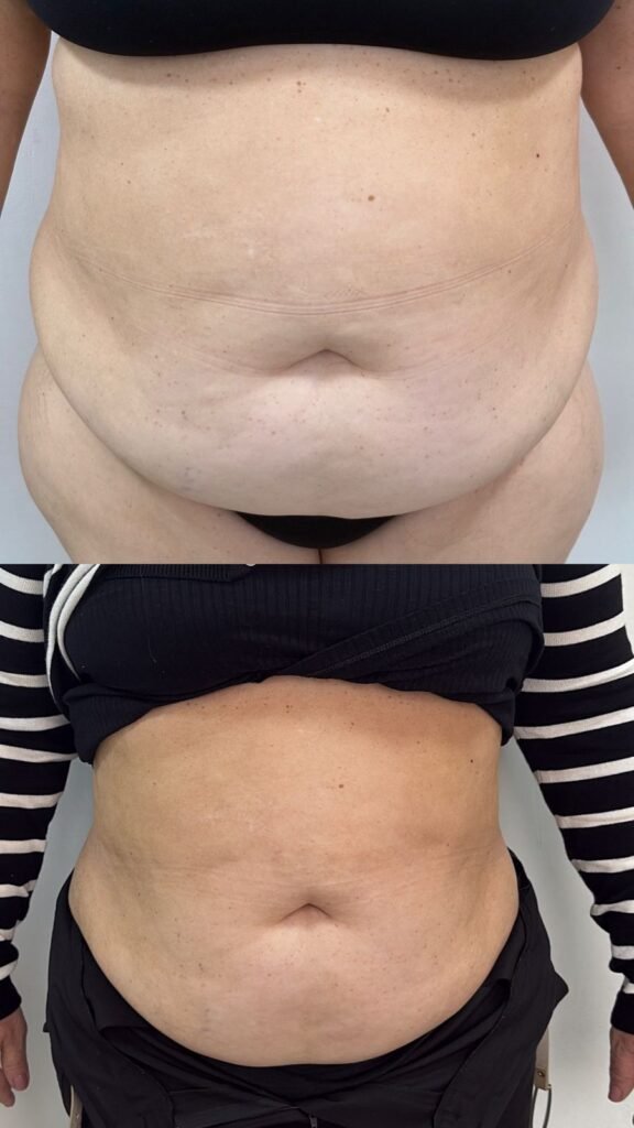 Antes e depois de criolipólise no abdômen - paciente 5 - Clínica Mayara Ribeiro