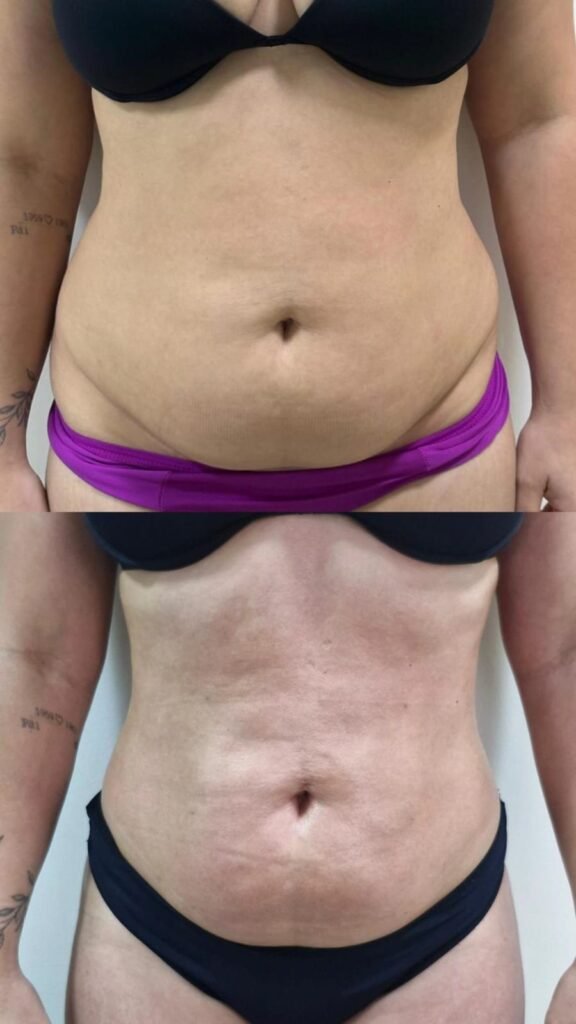 Antes e depois do Endoshape no abdômen - paciente 2