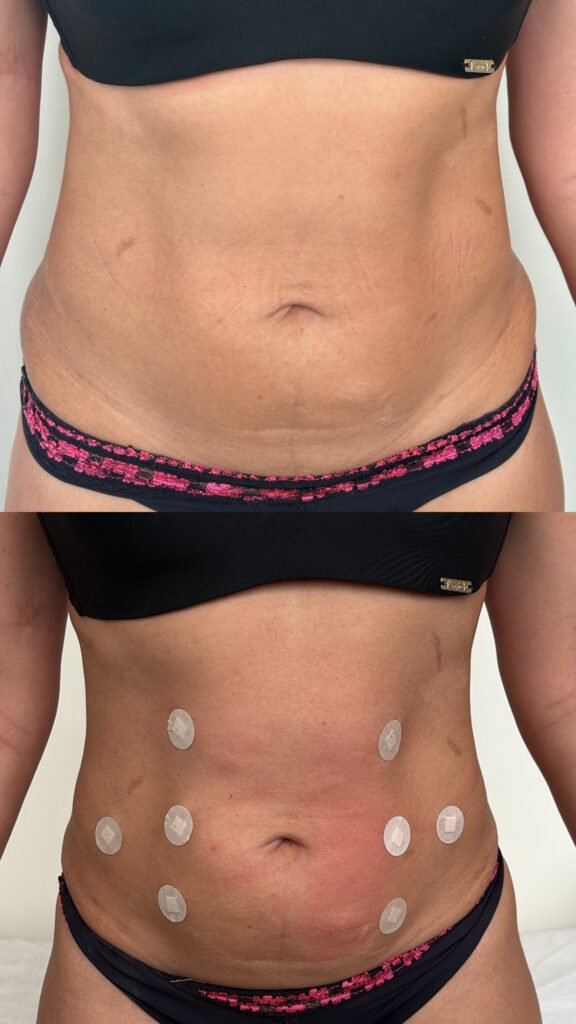 Antes e depois do Endoshape no abdômen - paciente 3