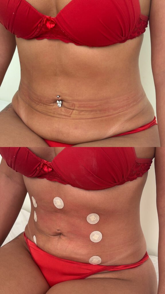 Antes e depois do Endoshape no abdômen - paciente 4