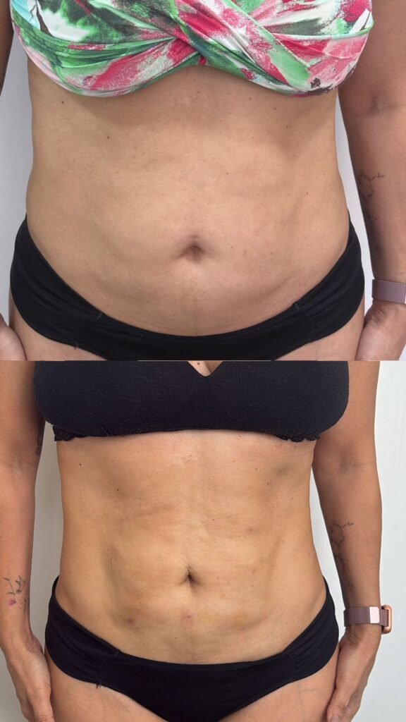Antes e depois do Endoshape no abdômen - paciente 1
